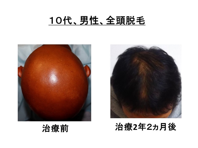 円形脱毛症　病院